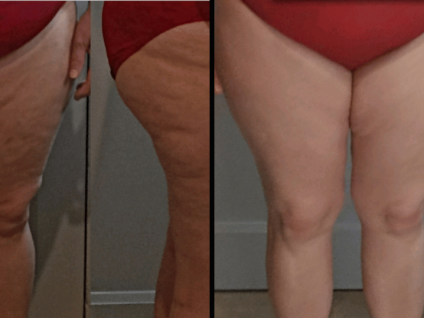 Avant / Après : les résultats visibles des séances minceur LoéZen